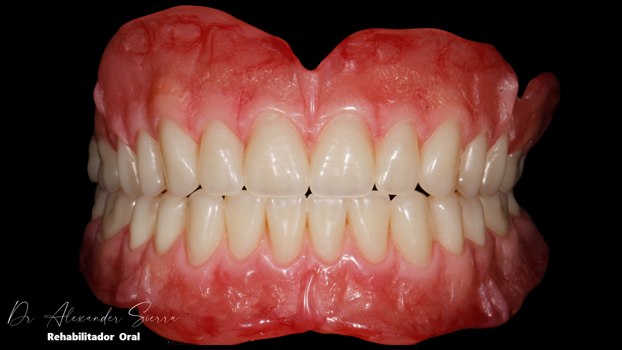 Oclusión en prótesis total bimaxilar 